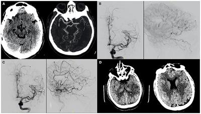 Etiologic Subtypes of Ischemic Stroke in SARS-CoV-2 Patients in a Cohort of New York City Hospitals